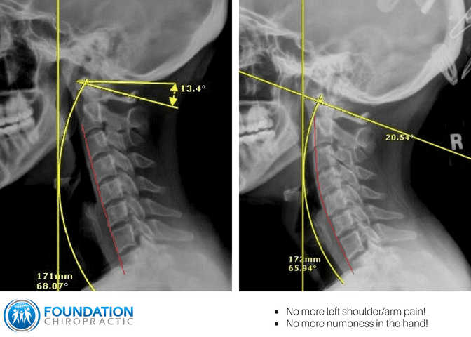 Before & After | Our Patient Successes | Foundation Chiropractic